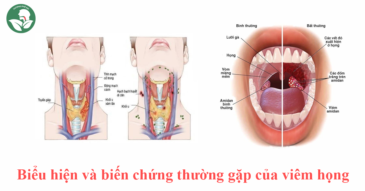 Nhận Biết Và Đề Phòng Bệnh Viêm Họng Khi Thời Tiết Chuyển Mùa