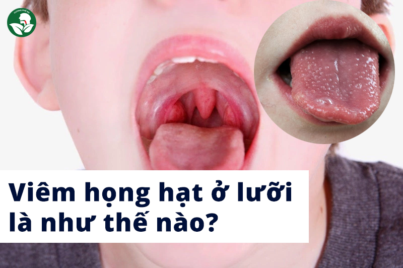 Viêm Họng Hạt Ở Lưỡi Và Những Thông Tin Cần Biết